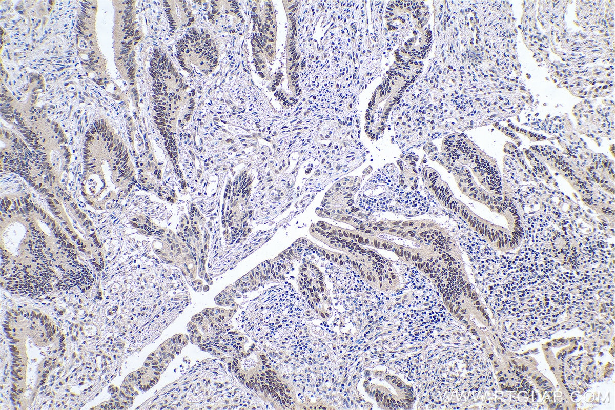 Immunohistochemical analysis of paraffin-embedded human colon cancer tissue slide using KHC0733 (MSH6 IHC Kit).