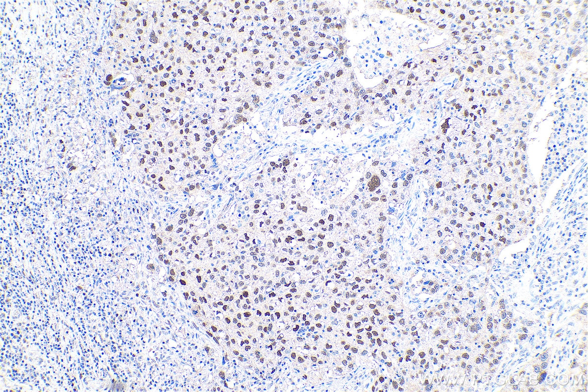 Immunohistochemical analysis of paraffin-embedded human lung cancer tissue slide using KHC0733 (MSH6 IHC Kit).