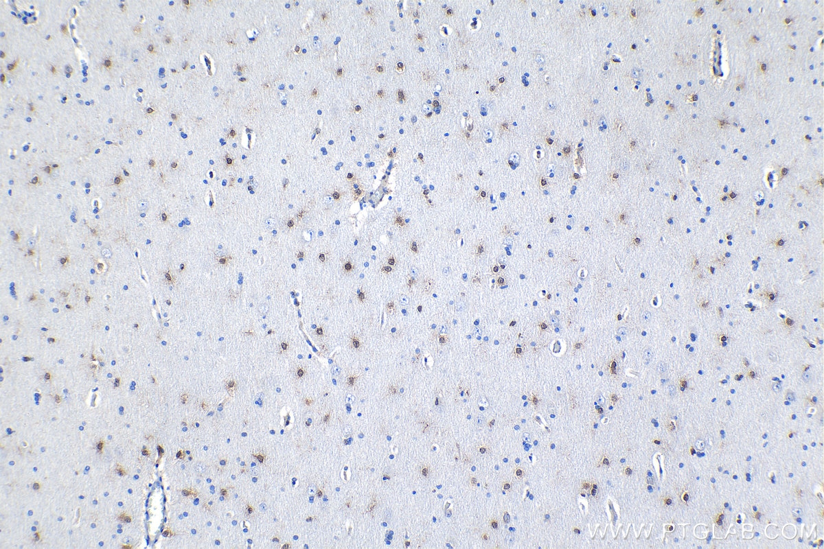 Immunohistochemical analysis of paraffin-embedded human gliomas tissue slide using KHC1211 (MSI1 IHC Kit).