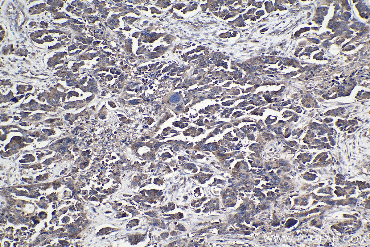 Immunohistochemical analysis of paraffin-embedded human colon cancer tissue slide using KHC1014 (MSI2 IHC Kit).