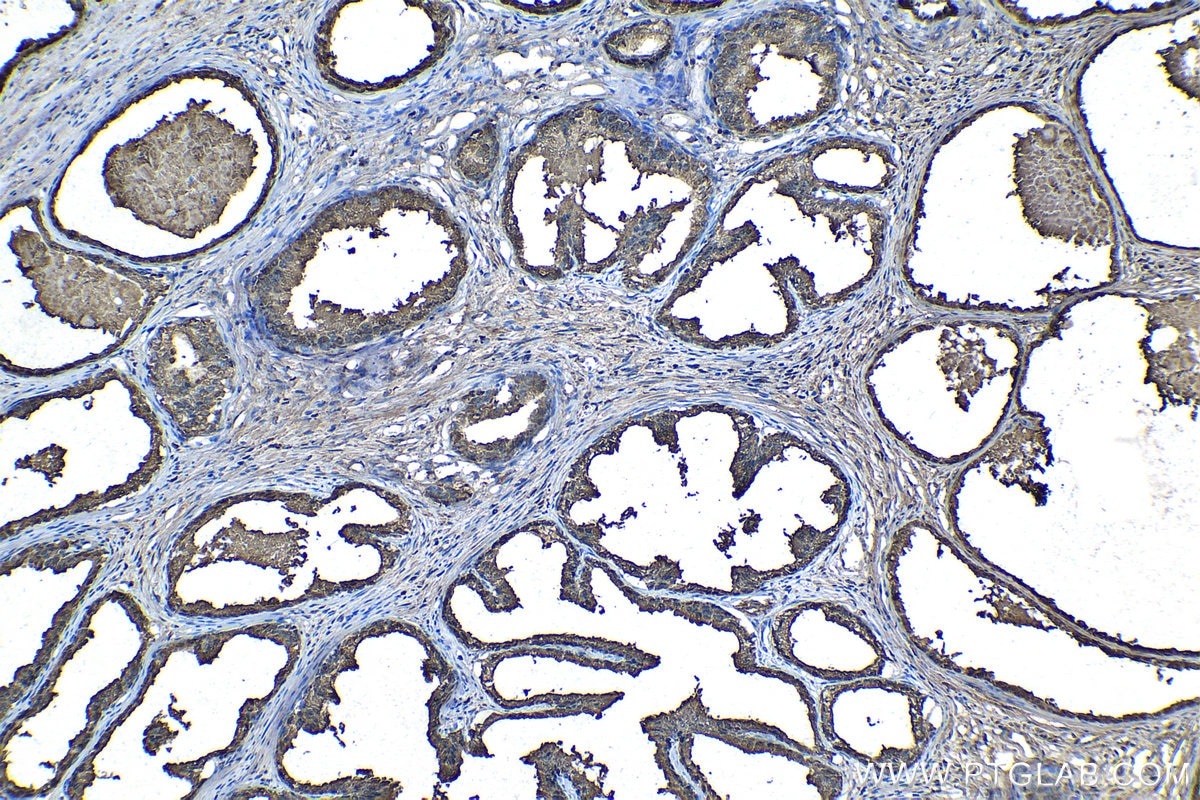 Immunohistochemical analysis of paraffin-embedded human prostate cancer tissue slide using KHC1106 (MSMB IHC Kit).