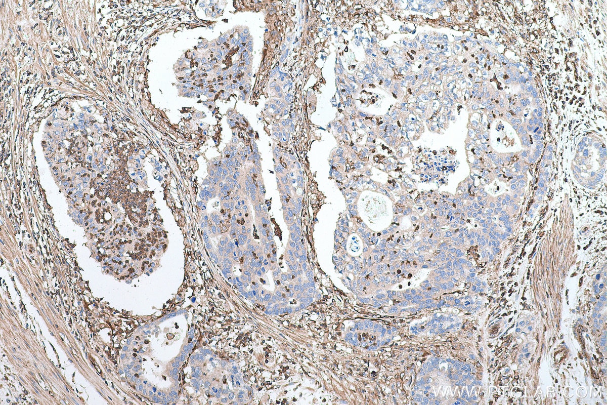 Immunohistochemical analysis of paraffin-embedded human stomach cancer tissue slide using KHC0664 (MSN IHC Kit).