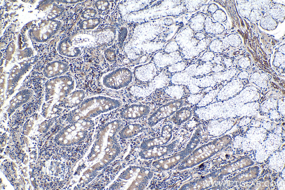 Immunohistochemical analysis of paraffin-embedded human stomach cancer tissue slide using KHC1262 (MSRB3 IHC Kit).