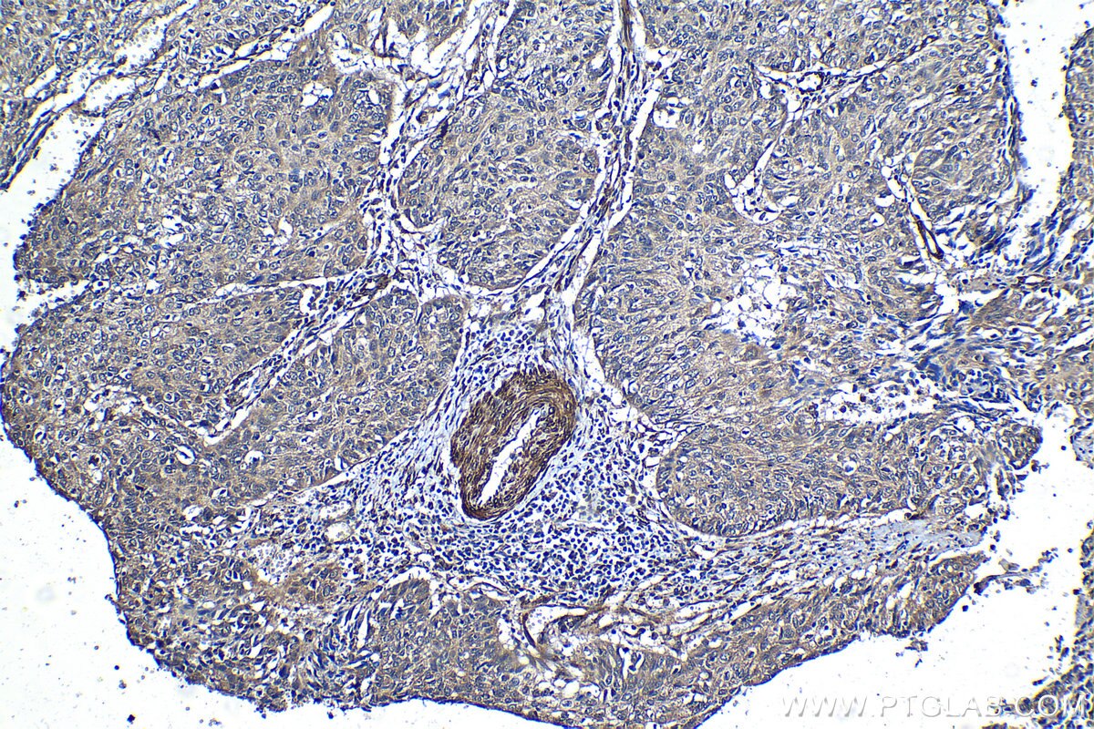 Immunohistochemical analysis of paraffin-embedded human cervical cancer tissue slide using KHC1262 (MSRB3 IHC Kit).