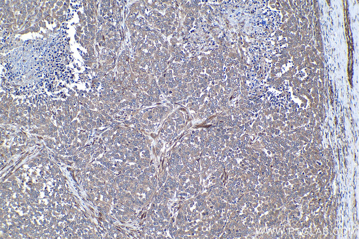 Immunohistochemical analysis of paraffin-embedded human ovary tumor tissue slide using KHC1262 (MSRB3 IHC Kit).