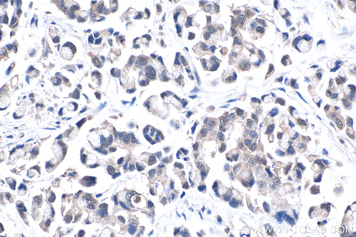 Immunohistochemical analysis of paraffin-embedded human colon cancer tissue slide using KHC0438 (MT2A IHC Kit).