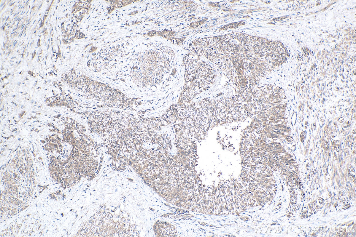 Immunohistochemical analysis of paraffin-embedded human urothelial carcinoma tissue slide using KHC0438 (MT2A IHC Kit).