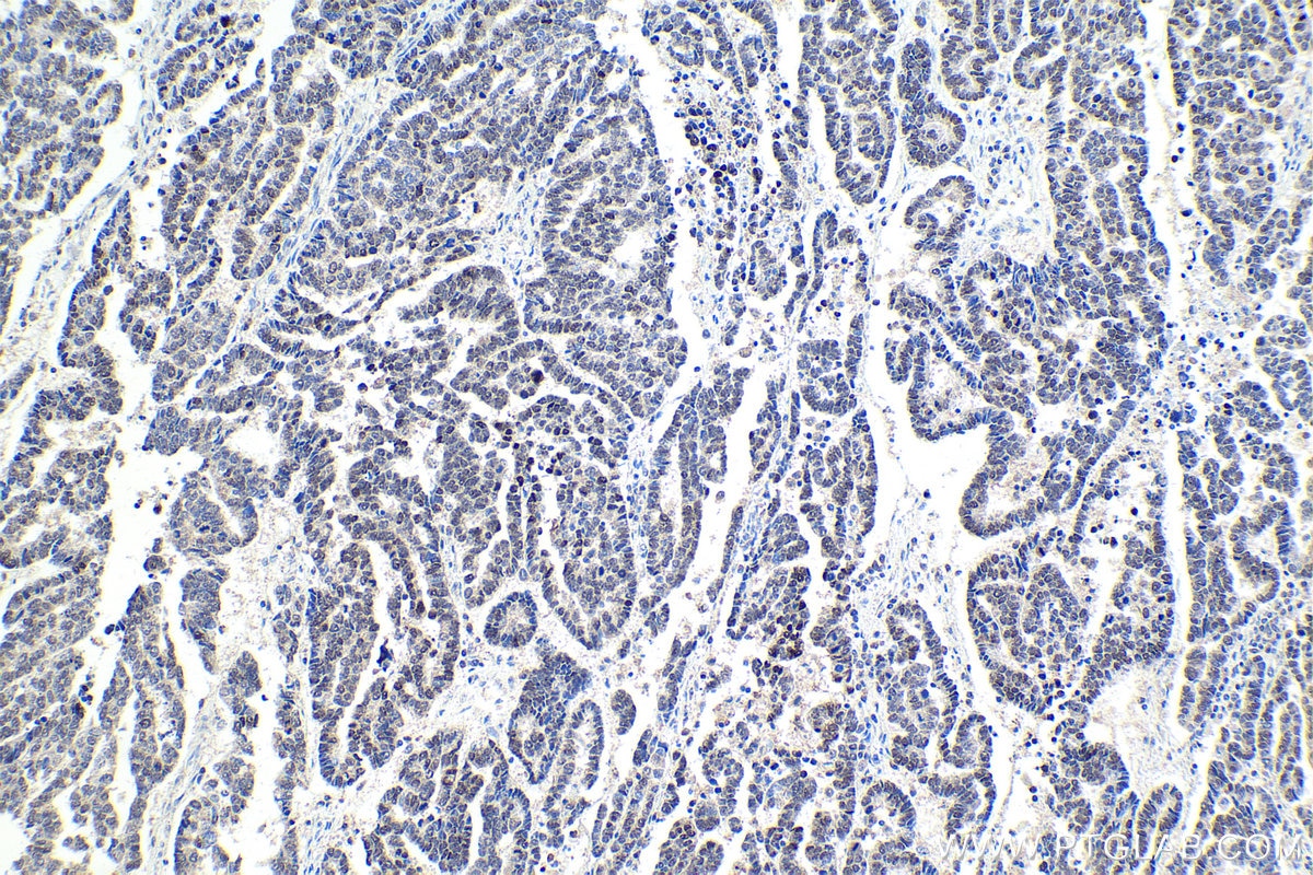 Immunohistochemical analysis of paraffin-embedded human ovary tumor tissue slide using KHC1710 (MTA1 IHC Kit).