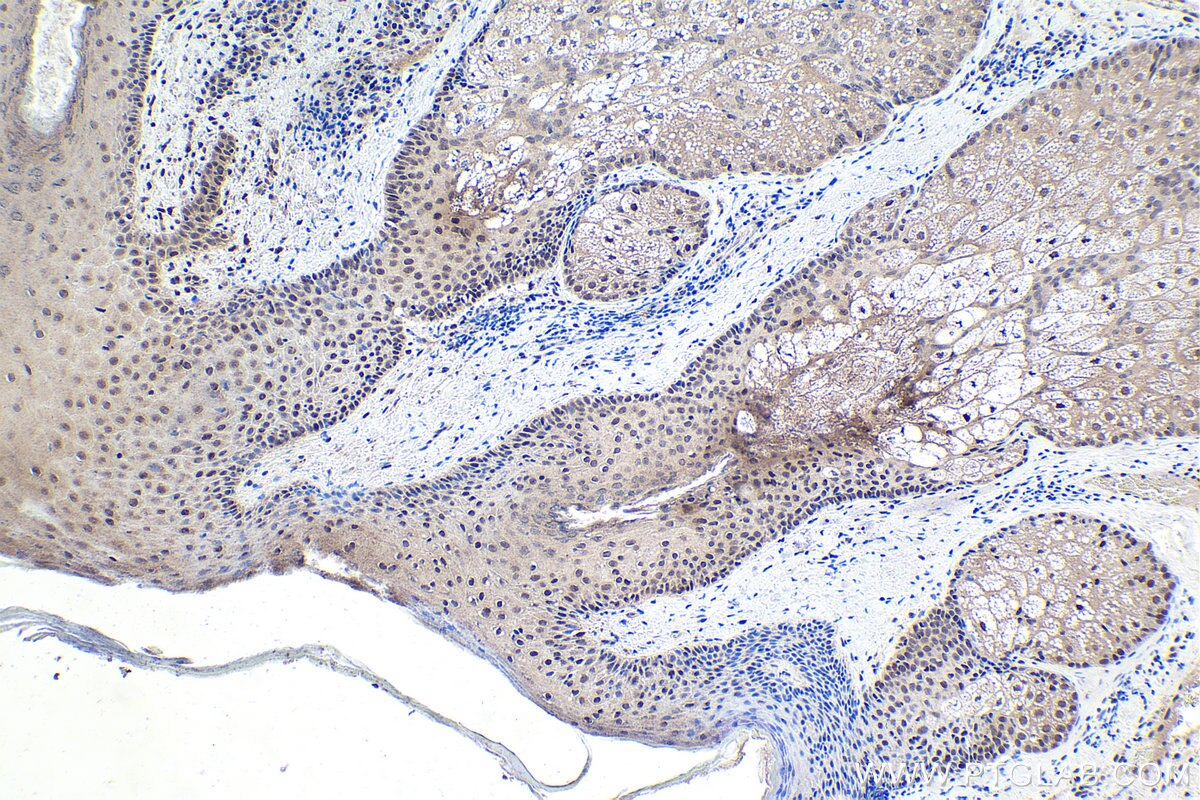 Immunohistochemical analysis of paraffin-embedded human skin cancer tissue slide using KHC1710 (MTA1 IHC Kit).