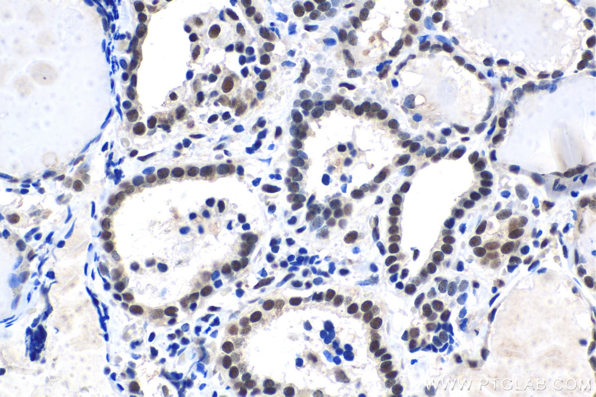 Immunohistochemical analysis of paraffin-embedded human thyroid cancer tissue slide using KHC1481 (MTA2 IHC Kit).