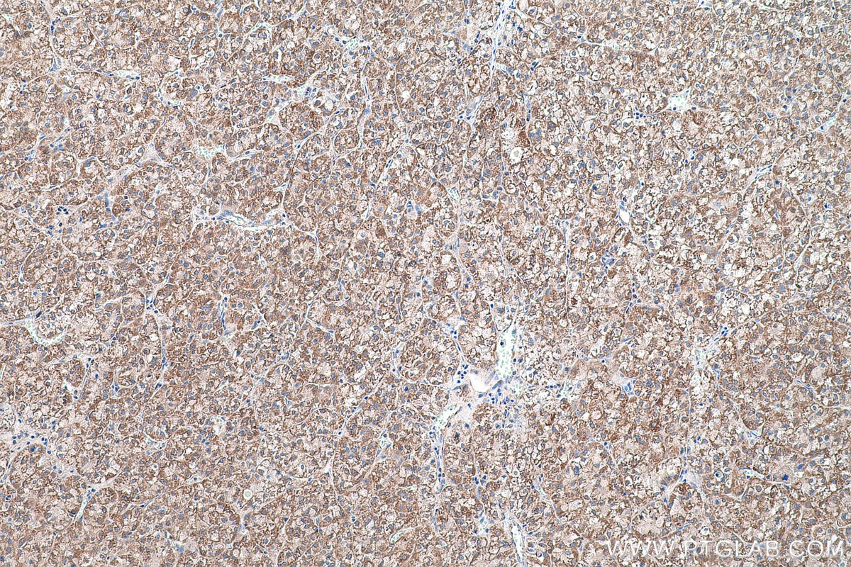 Immunohistochemical analysis of paraffin-embedded human liver cancer tissue slide using KHC0575 (MTCO2 IHC Kit).