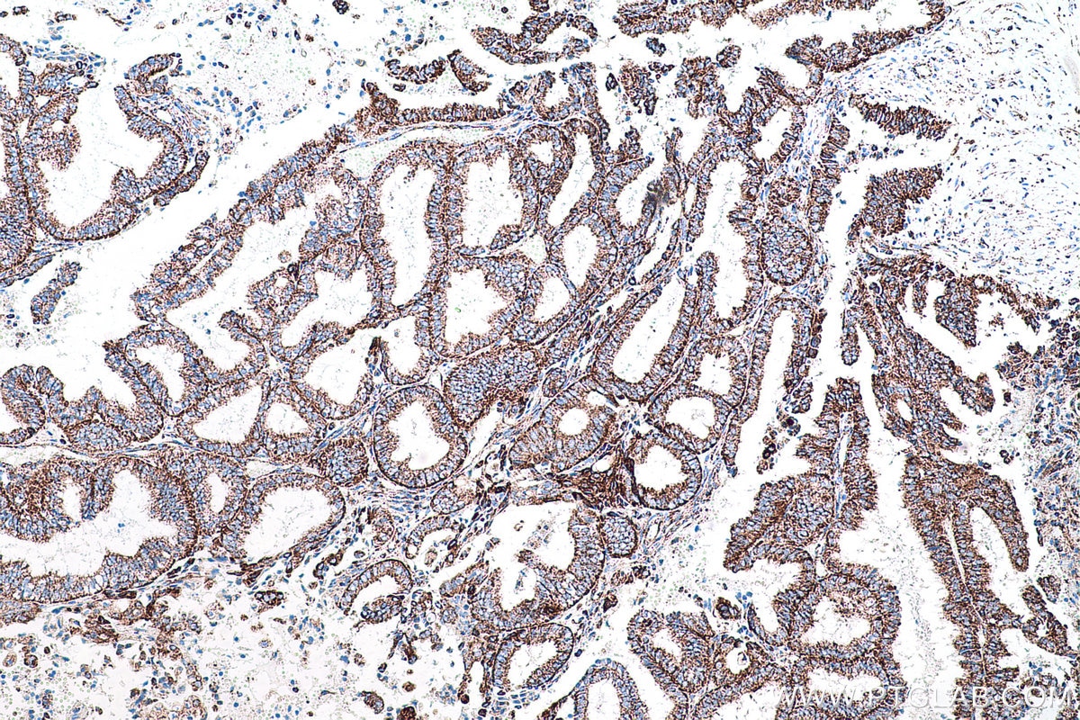 Immunohistochemical analysis of paraffin-embedded human ovary tumor tissue slide using KHC0575 (MTCO2 IHC Kit).