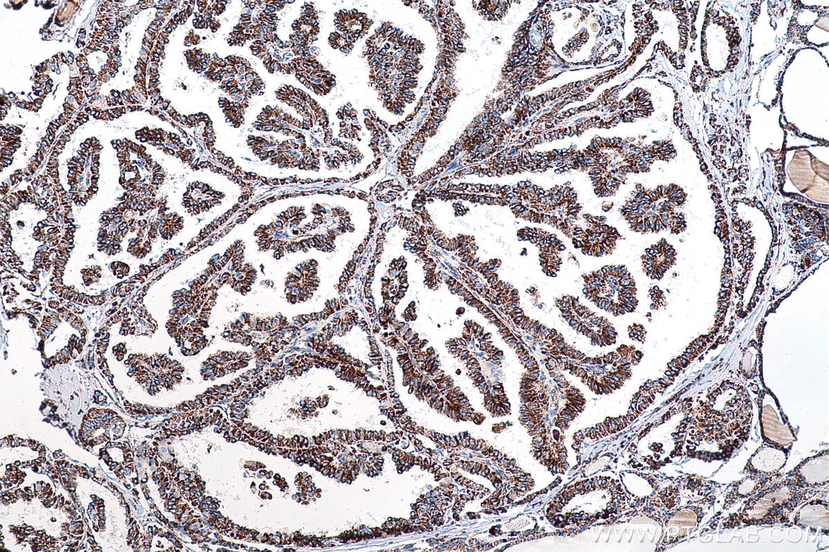 Immunohistochemical analysis of paraffin-embedded human thyroid cancer tissue slide using KHC0575 (MTCO2 IHC Kit).