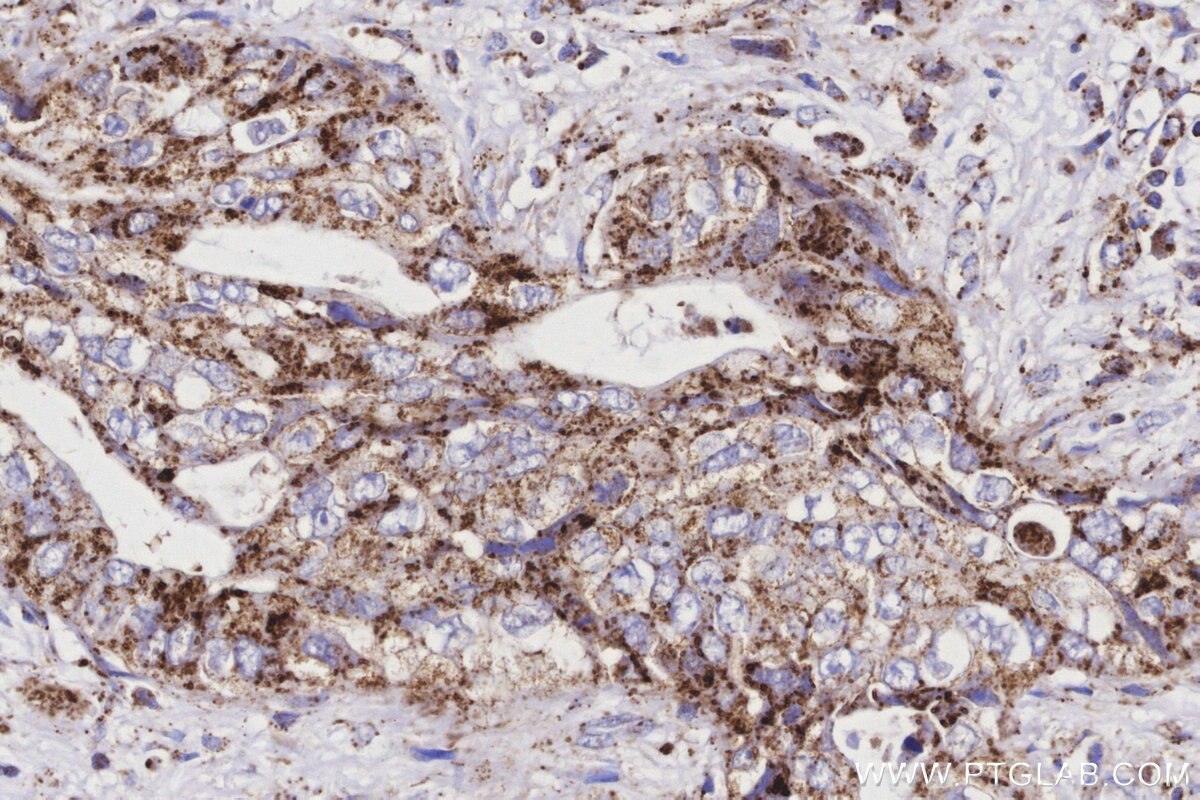 Immunohistochemical analysis of paraffin-embedded human pancreas cancer tissue slide using KHC3160 (MTCO3 IHC Kit).