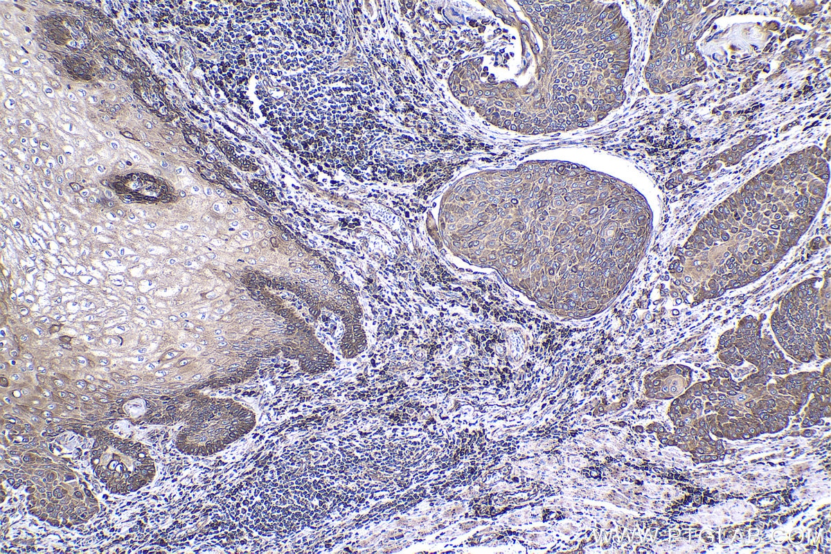 Immunohistochemical analysis of paraffin-embedded human oesophagus cancer tissue slide using KHC1366 (MTDH IHC Kit).