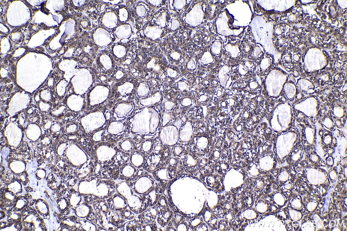 Immunohistochemical analysis of paraffin-embedded human thyroid cancer tissue slide using KHC1366 (MTDH IHC Kit).