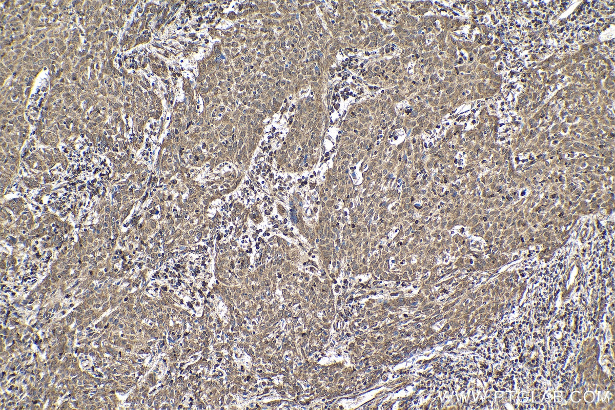 Immunohistochemical analysis of paraffin-embedded human cervical cancer tissue slide using KHC1738 (MTF1 IHC Kit).