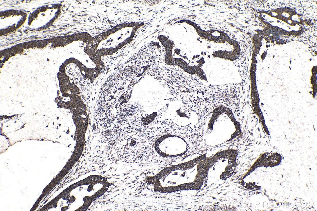 Immunohistochemical analysis of paraffin-embedded human urothelial carcinoma tissue slide using KHC1738 (MTF1 IHC Kit).