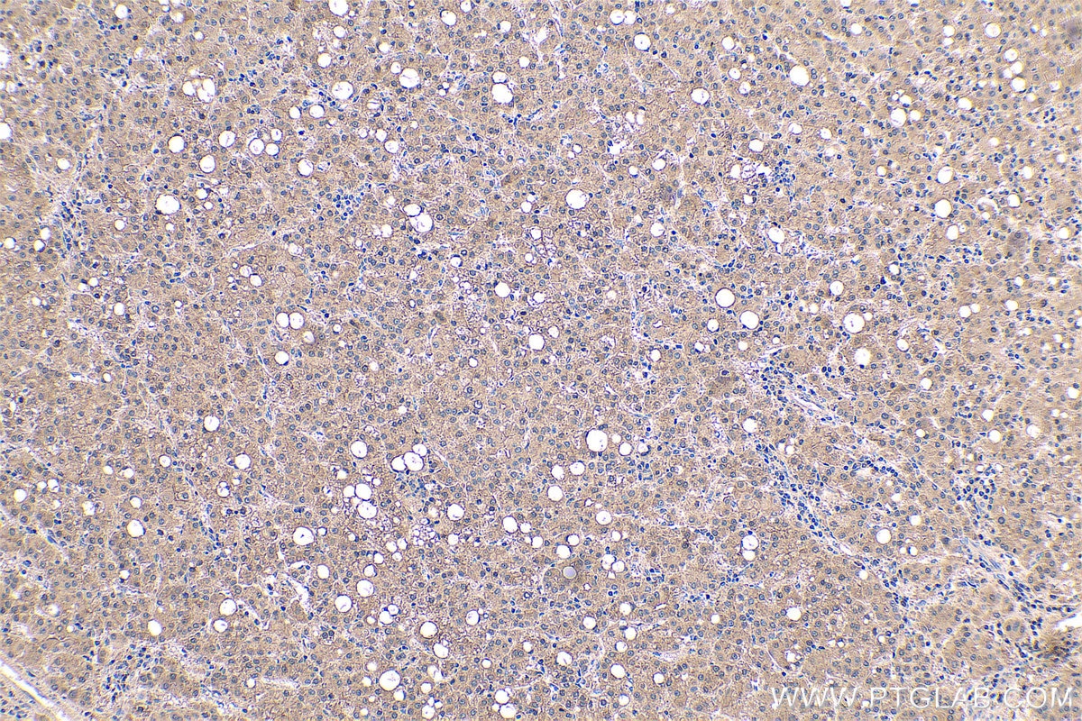 Immunohistochemical analysis of paraffin-embedded human liver cancer tissue slide using KHC0578 (MTHFD1 IHC Kit).