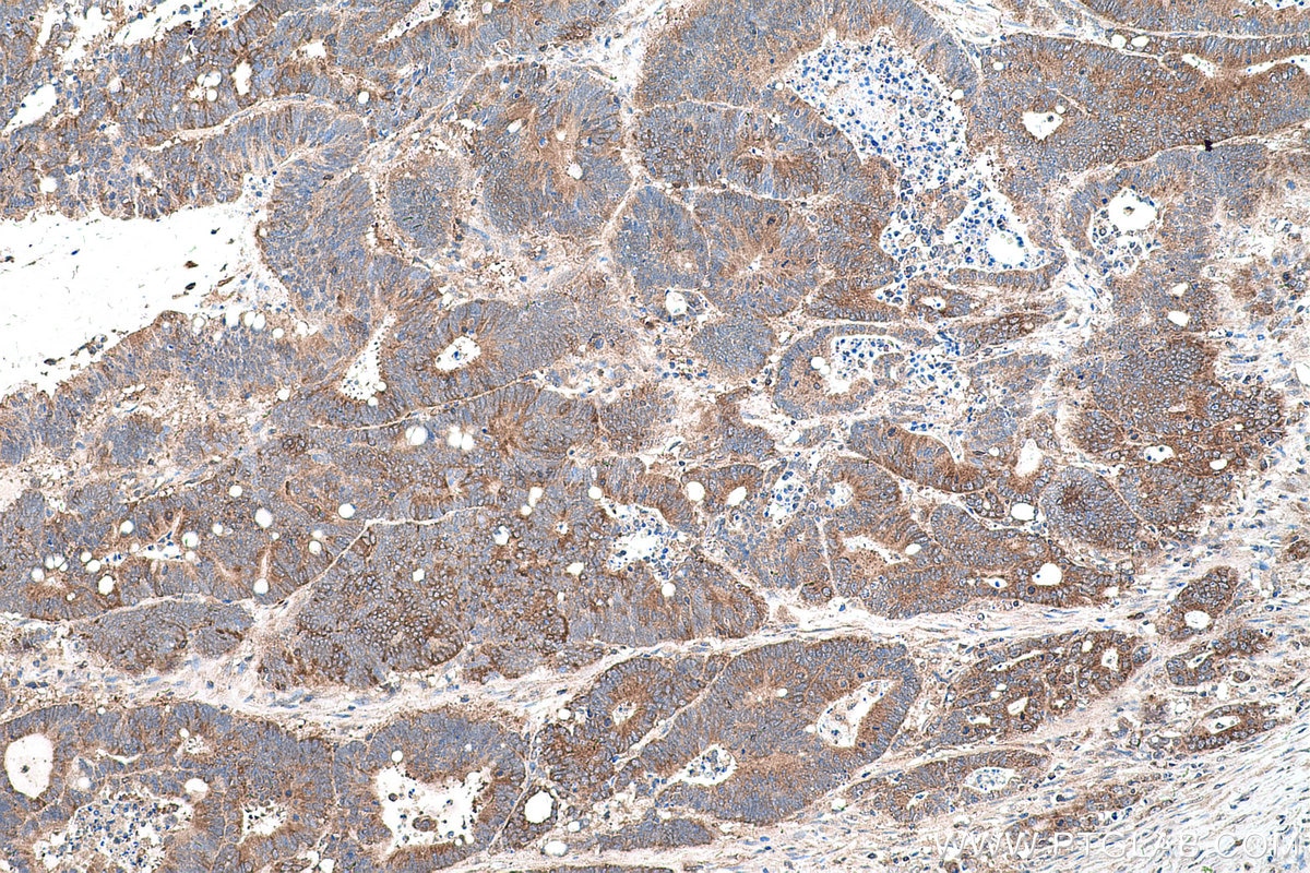Immunohistochemical analysis of paraffin-embedded human colon cancer tissue slide using KHC0578 (MTHFD1 IHC Kit).