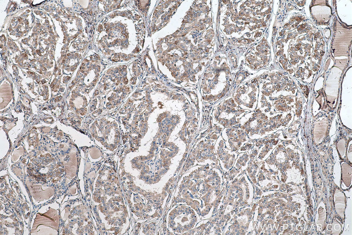 Immunohistochemical analysis of paraffin-embedded human thyroid cancer tissue slide using KHC0578 (MTHFD1 IHC Kit).