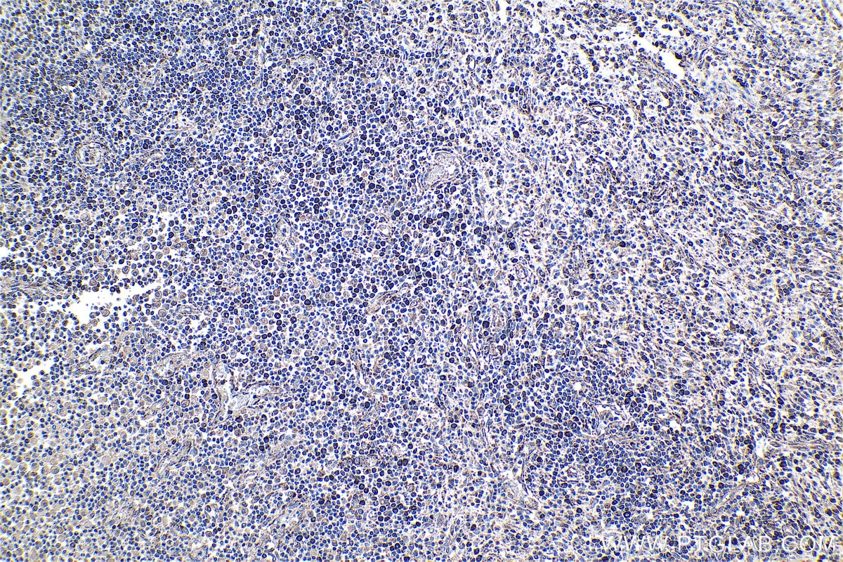 Immunohistochemical analysis of paraffin-embedded human colon cancer tissue slide using KHC0974 (MTHFD2 IHC Kit).