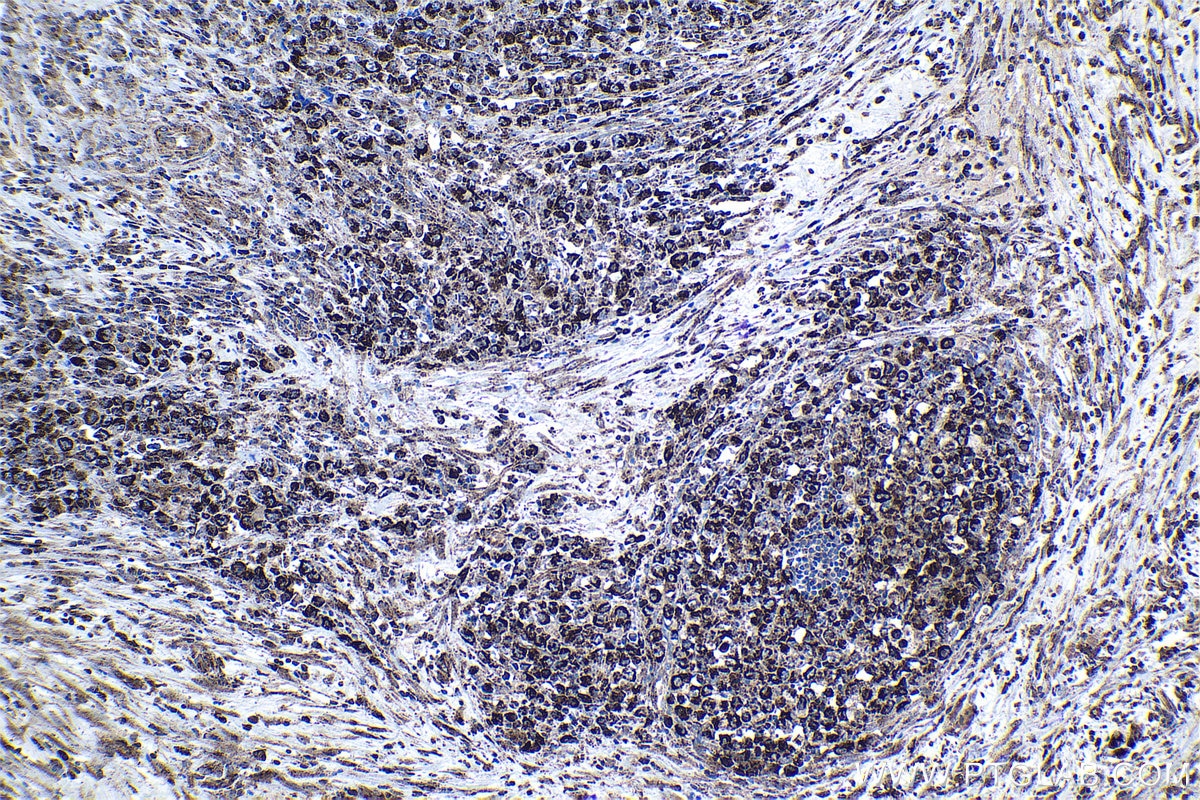 Immunohistochemical analysis of paraffin-embedded human lymphoma tissue slide using KHC0974 (MTHFD2 IHC Kit).