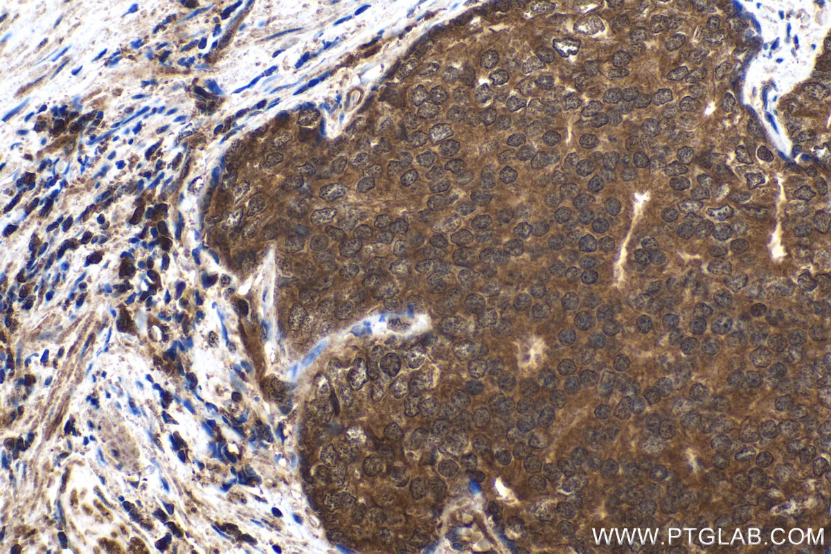 Immunohistochemical analysis of paraffin-embedded human prostate cancer tissue slide using KHC1635 (MTPN IHC Kit).