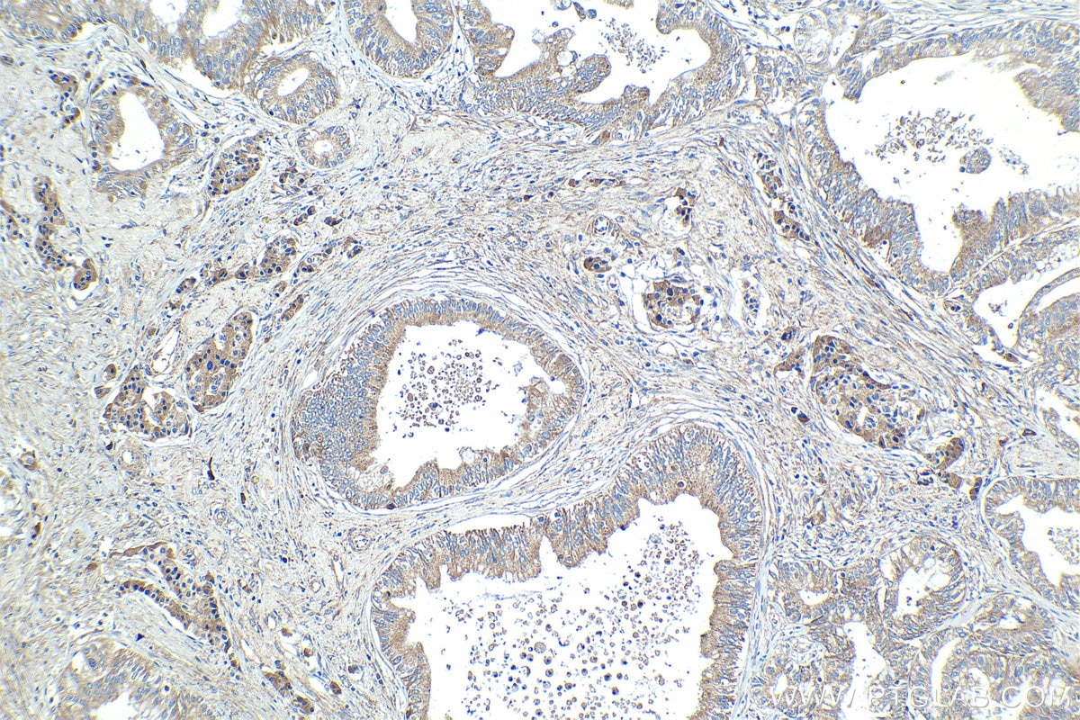 Immunohistochemical analysis of paraffin-embedded human pancreas cancer tissue slide using KHC1217 (MTR IHC Kit).