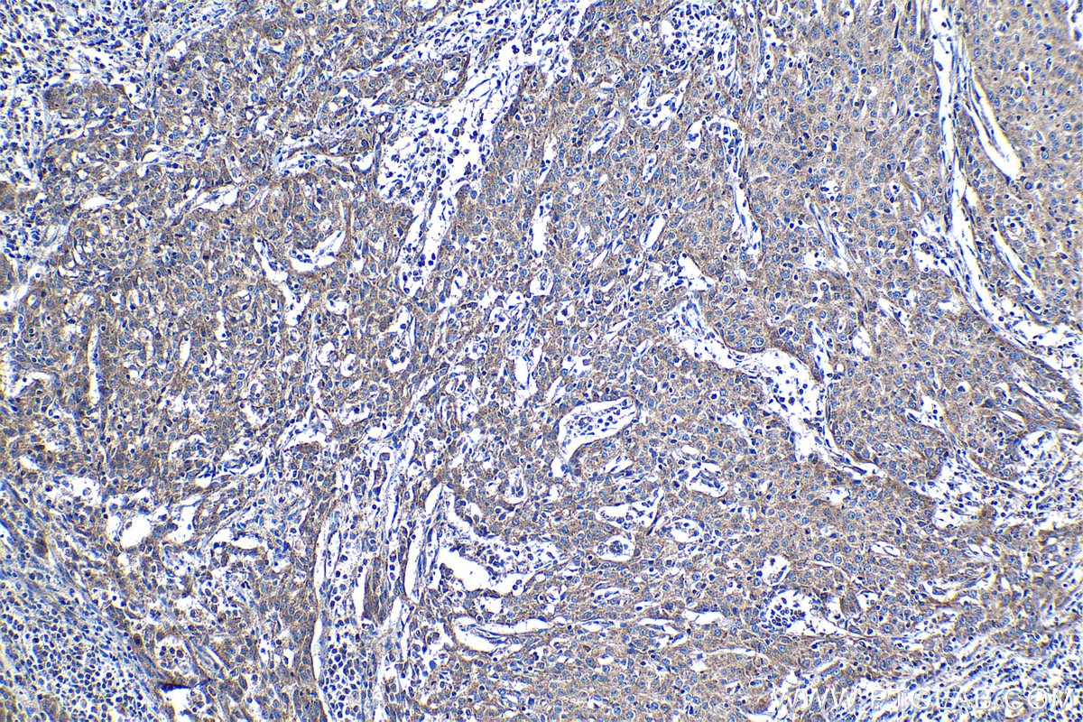 Immunohistochemical analysis of paraffin-embedded human cervical cancer tissue slide using KHC1217 (MTR IHC Kit).