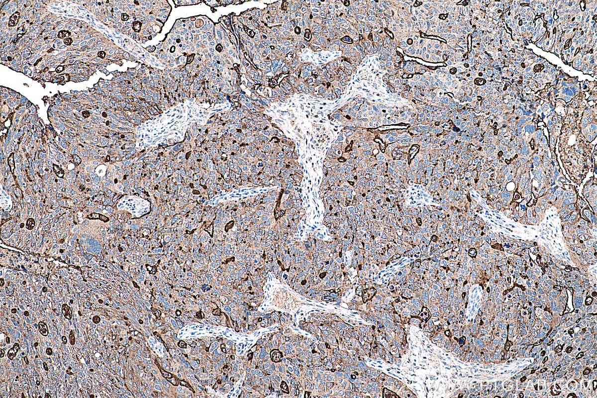 Immunohistochemical analysis of paraffin-embedded human ovary tumor tissue slide using KHC0304 (MUC1 IHC Kit).