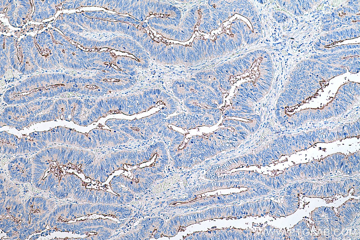 Immunohistochemical analysis of paraffin-embedded human colon cancer tissue slide using KHC0304 (MUC1 IHC Kit).