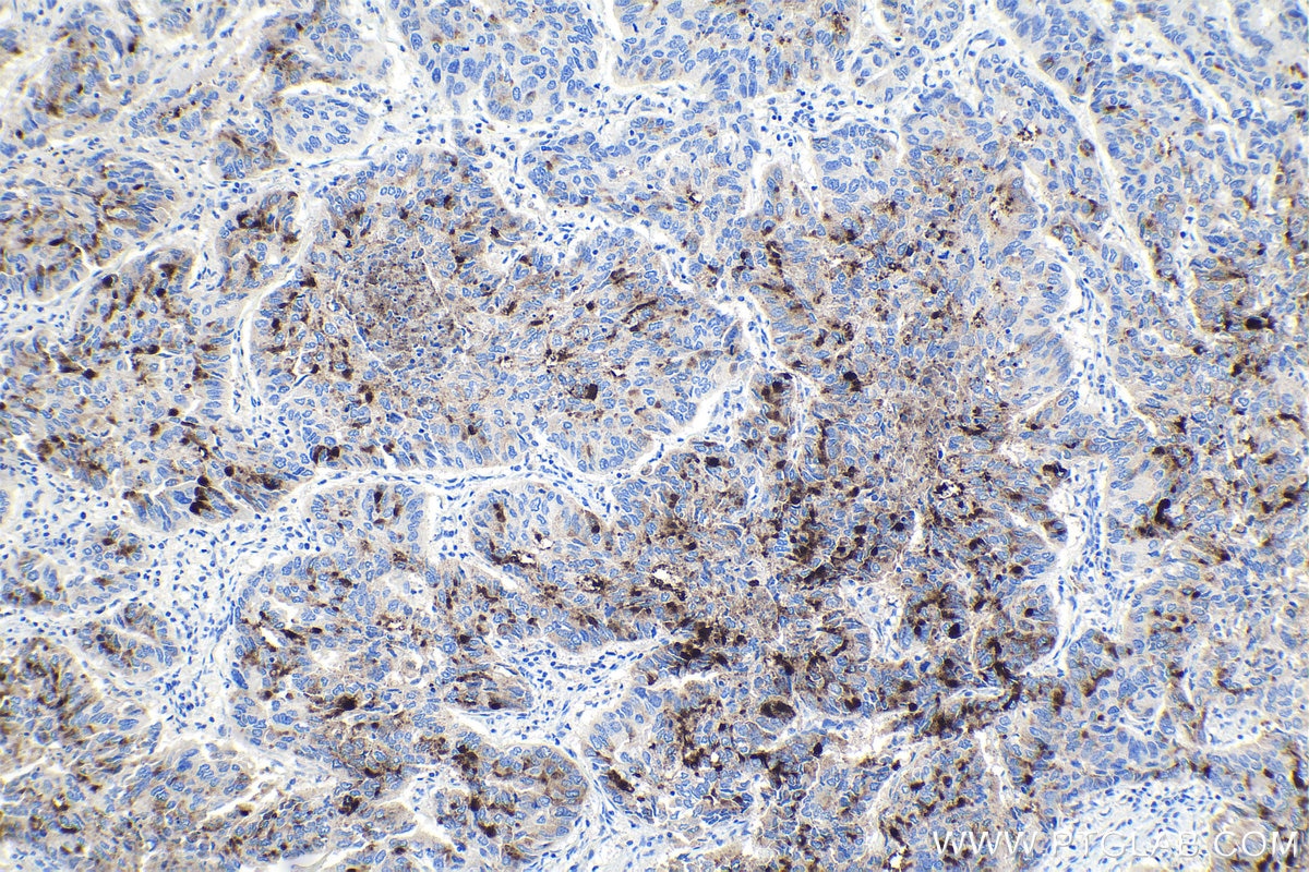 Immunohistochemical analysis of paraffin-embedded human lung cancer tissue slide using KHC1093 (MUC5B IHC Kit).
