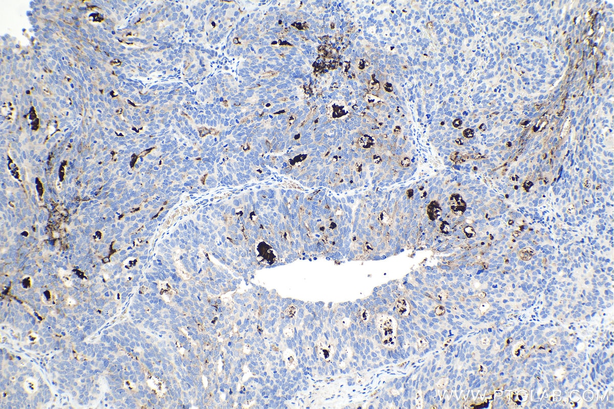 Immunohistochemical analysis of paraffin-embedded human ovary tumor tissue slide using KHC1093 (MUC5B IHC Kit).