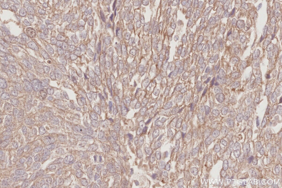 Immunohistochemical analysis of paraffin-embedded human ovary cancer tissue slide using KHC2899 (MUDENG IHC Kit).