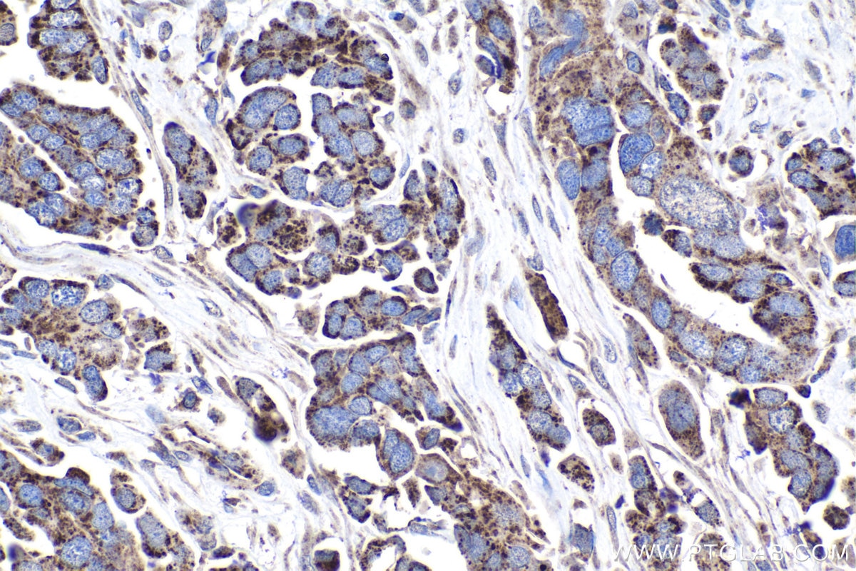 Immunohistochemical analysis of paraffin-embedded human colon cancer tissue slide using KHC1021 (MUT IHC Kit).