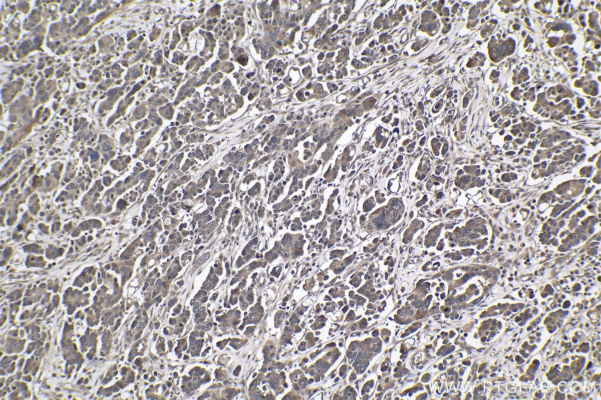 Immunohistochemical analysis of paraffin-embedded human colon cancer tissue slide using KHC1011 (MYBBP1A IHC Kit).