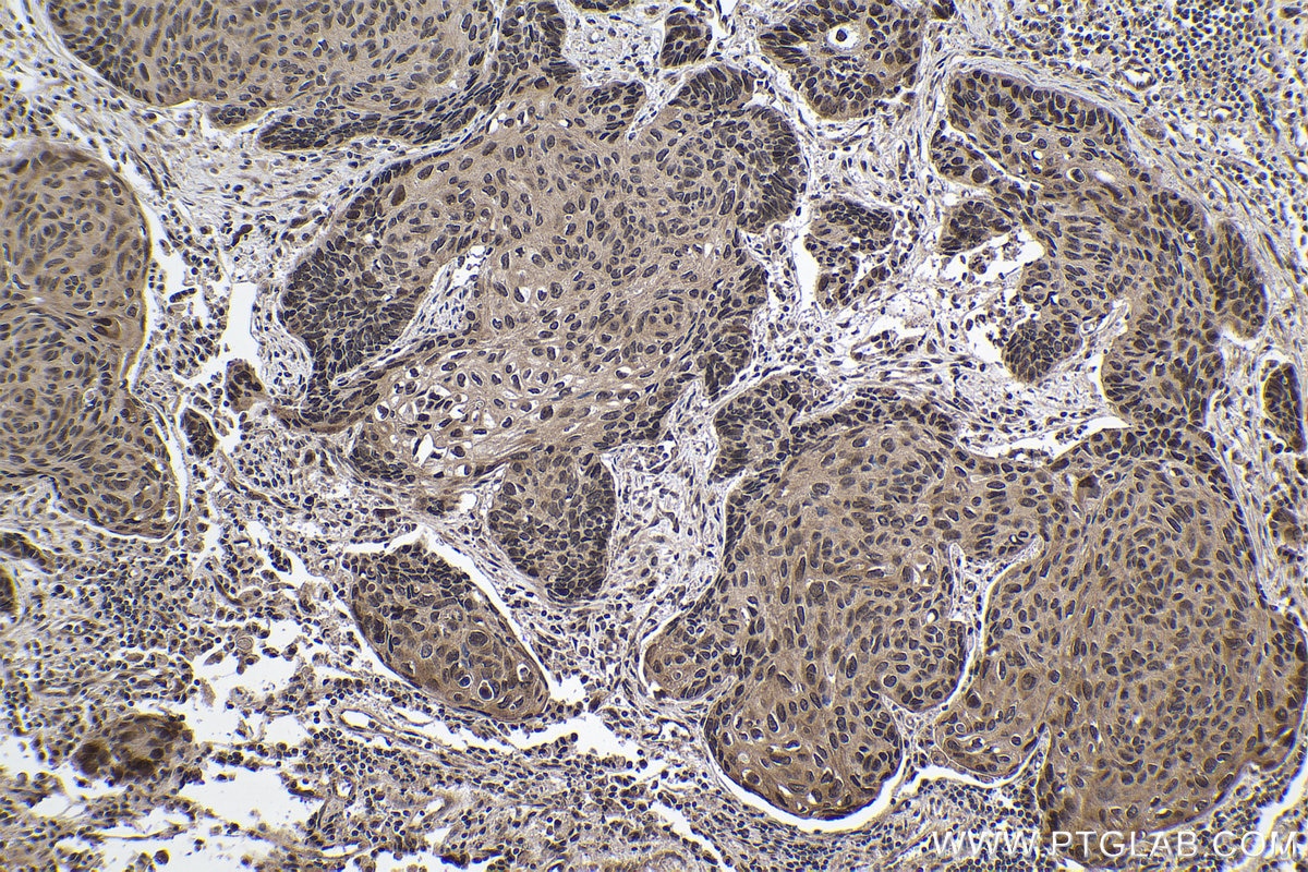 Immunohistochemical analysis of paraffin-embedded human lung cancer tissue slide using KHC1011 (MYBBP1A IHC Kit).
