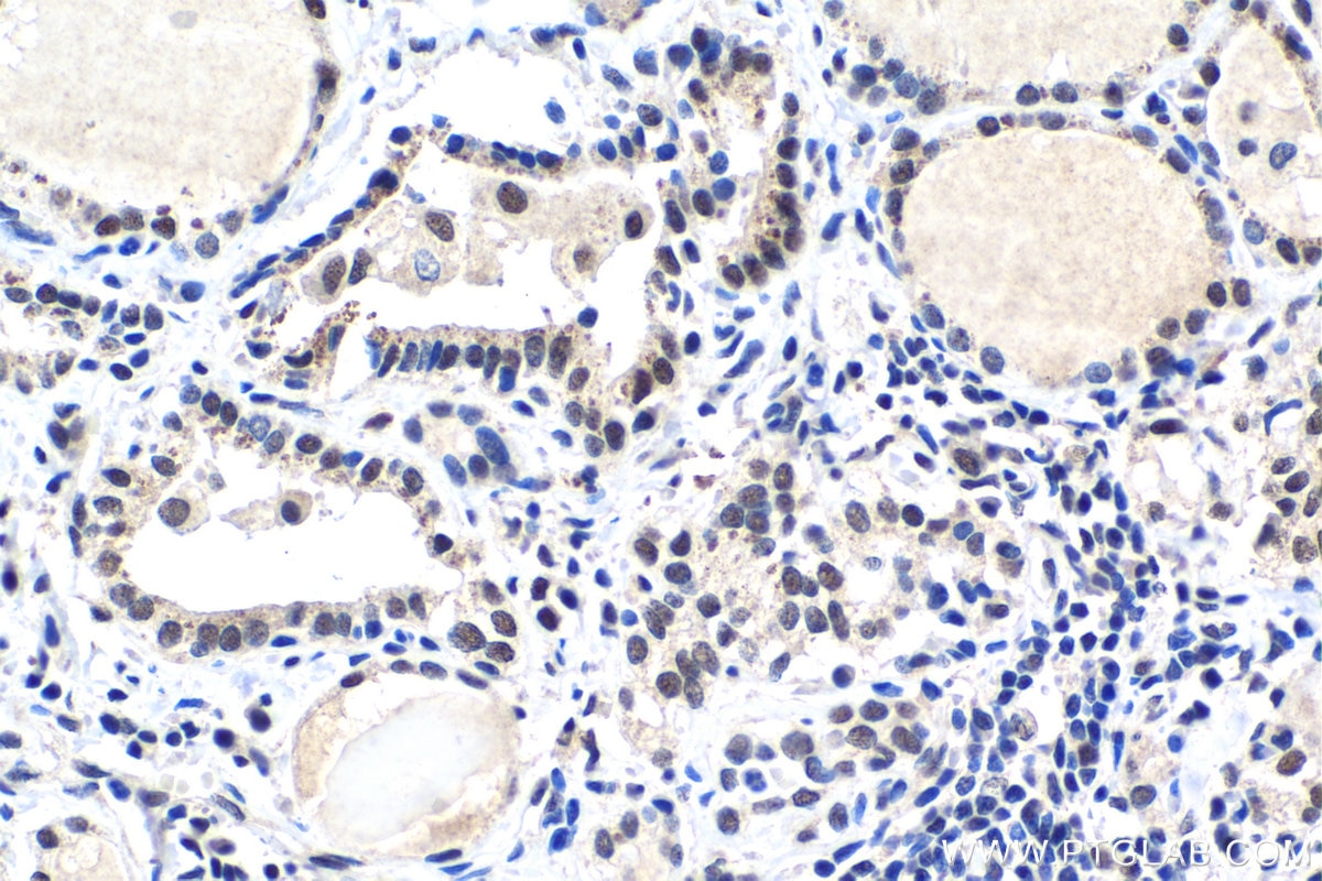 Immunohistochemical analysis of paraffin-embedded human thyroid cancer tissue slide using KHC1520 (MYBL2 IHC Kit).