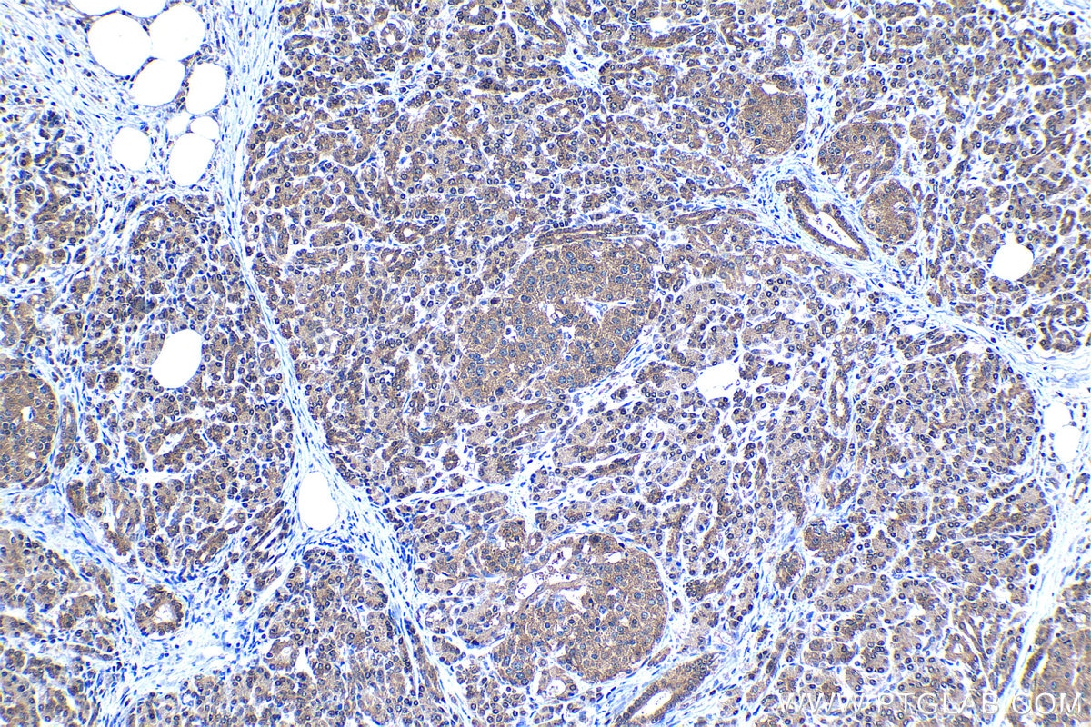 Immunohistochemical analysis of paraffin-embedded human pancreas cancer tissue slide using KHC1367 (MYCBP IHC Kit).