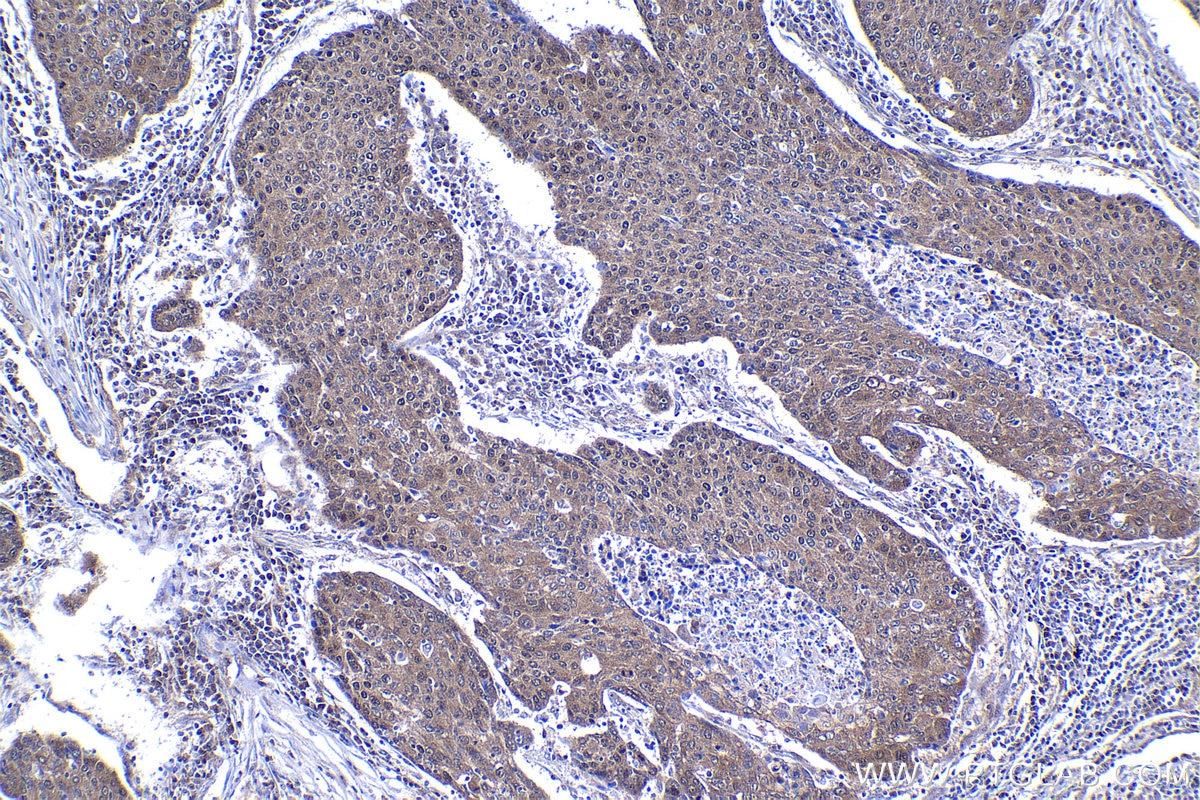 Immunohistochemical analysis of paraffin-embedded human lung cancer tissue slide using KHC1367 (MYCBP IHC Kit).