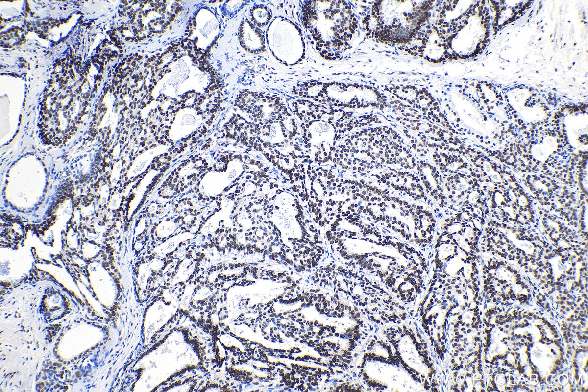 Immunohistochemical analysis of paraffin-embedded human breast cancer tissue slide using KHC1385 (MYEF2 IHC Kit).