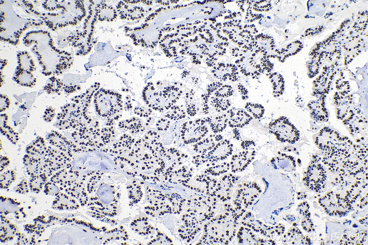 Immunohistochemical analysis of paraffin-embedded human thyroid cancer tissue slide using KHC1385 (MYEF2 IHC Kit).