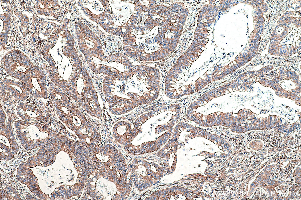 Immunohistochemical analysis of paraffin-embedded human colon cancer tissue slide using KHC0365 (MYH9 IHC Kit).