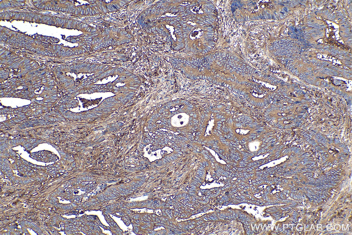 Immunohistochemical analysis of paraffin-embedded human colon cancer tissue slide using KHC0348 (MYL12A IHC Kit).