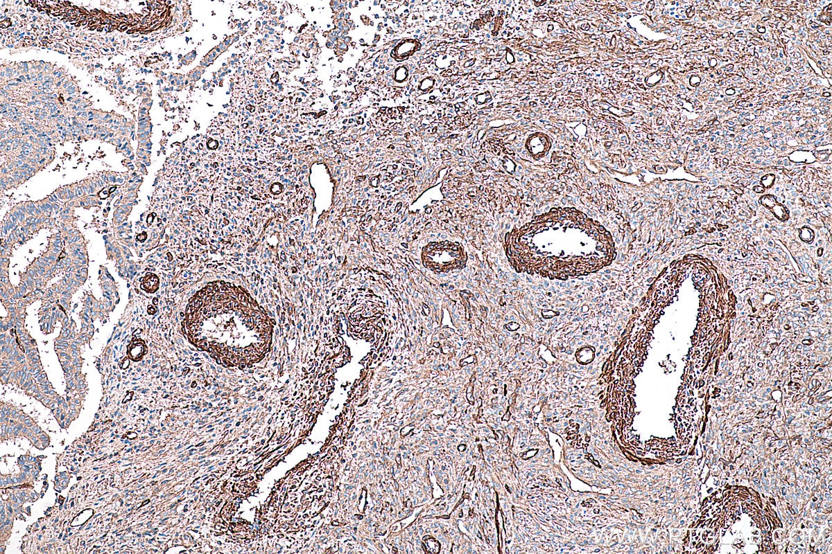 Immunohistochemical analysis of paraffin-embedded human ovary tumor tissue slide using KHC0345 (MYL9 IHC Kit).