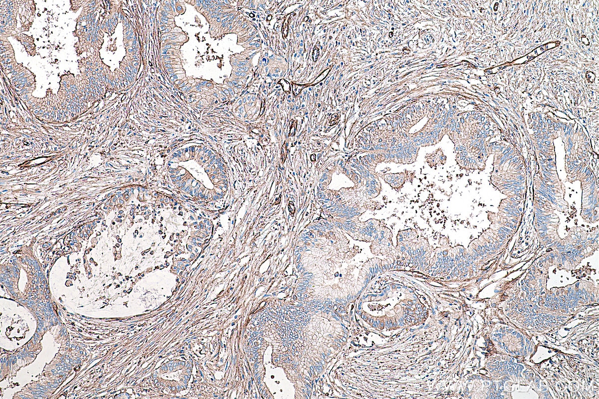 Immunohistochemical analysis of paraffin-embedded human pancreas cancer tissue slide using KHC0345 (MYL9 IHC Kit).