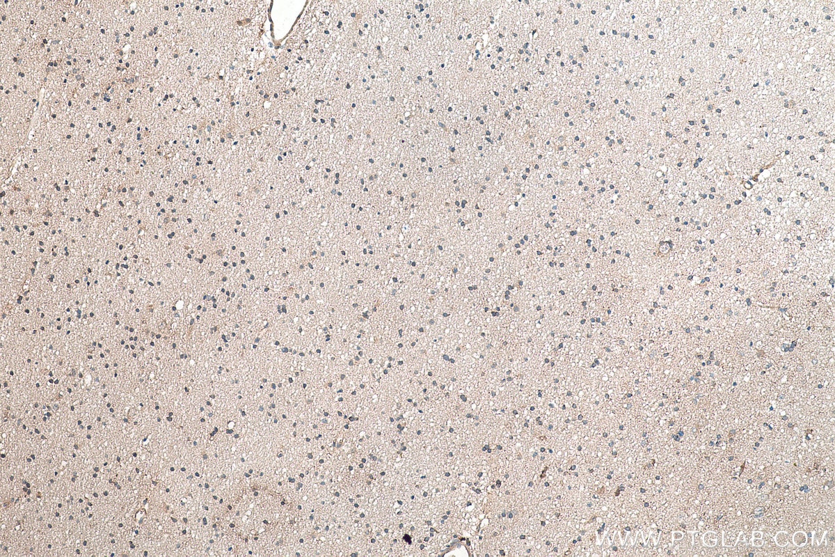 Immunohistochemical analysis of paraffin-embedded human gliomas tissue slide using KHC0359 (MYO16 IHC Kit).