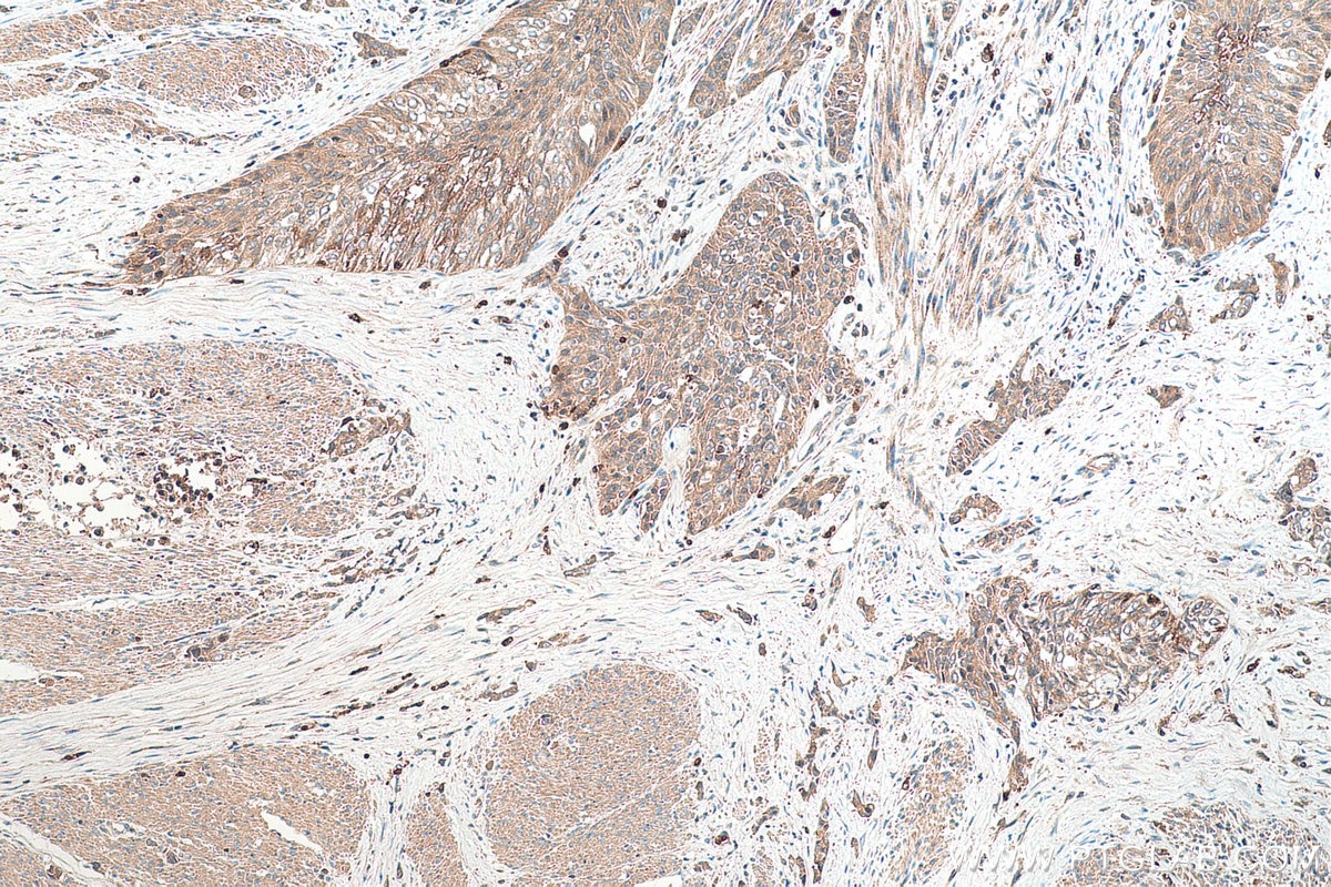 Immunohistochemical analysis of paraffin-embedded human urothelial carcinoma tissue slide using KHC0359 (MYO16 IHC Kit).