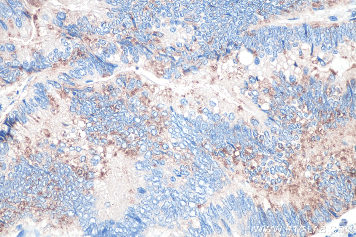 Immunohistochemical analysis of paraffin-embedded human colon cancer tissue slide using KHC0361 (MYO18B IHC Kit).